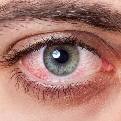 irritated-red-bloodshot-eye